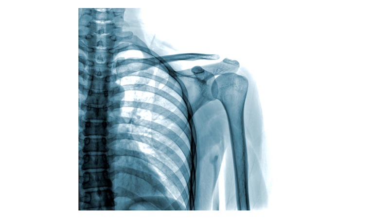 تشخیص شکستگی و دررفتگی استخوان شانه با رادیوگرافی | سونوگرافی پستان اصفهان