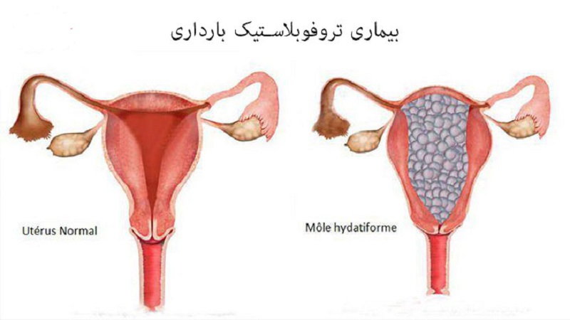 سونوگرافی بهترین روش تشخیص بیماری های تروفوبلاستیک بارداری | سونوگرافی پستان اصفهان