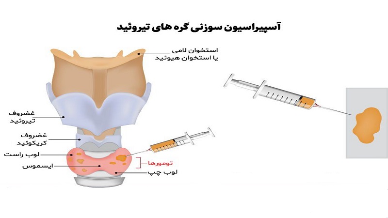 مزایا و عوارض انجام آسپیراسیون سوزنی (FNA) | سونوگرافی پستان اصفهان